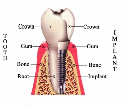 dental_implant2.jpg